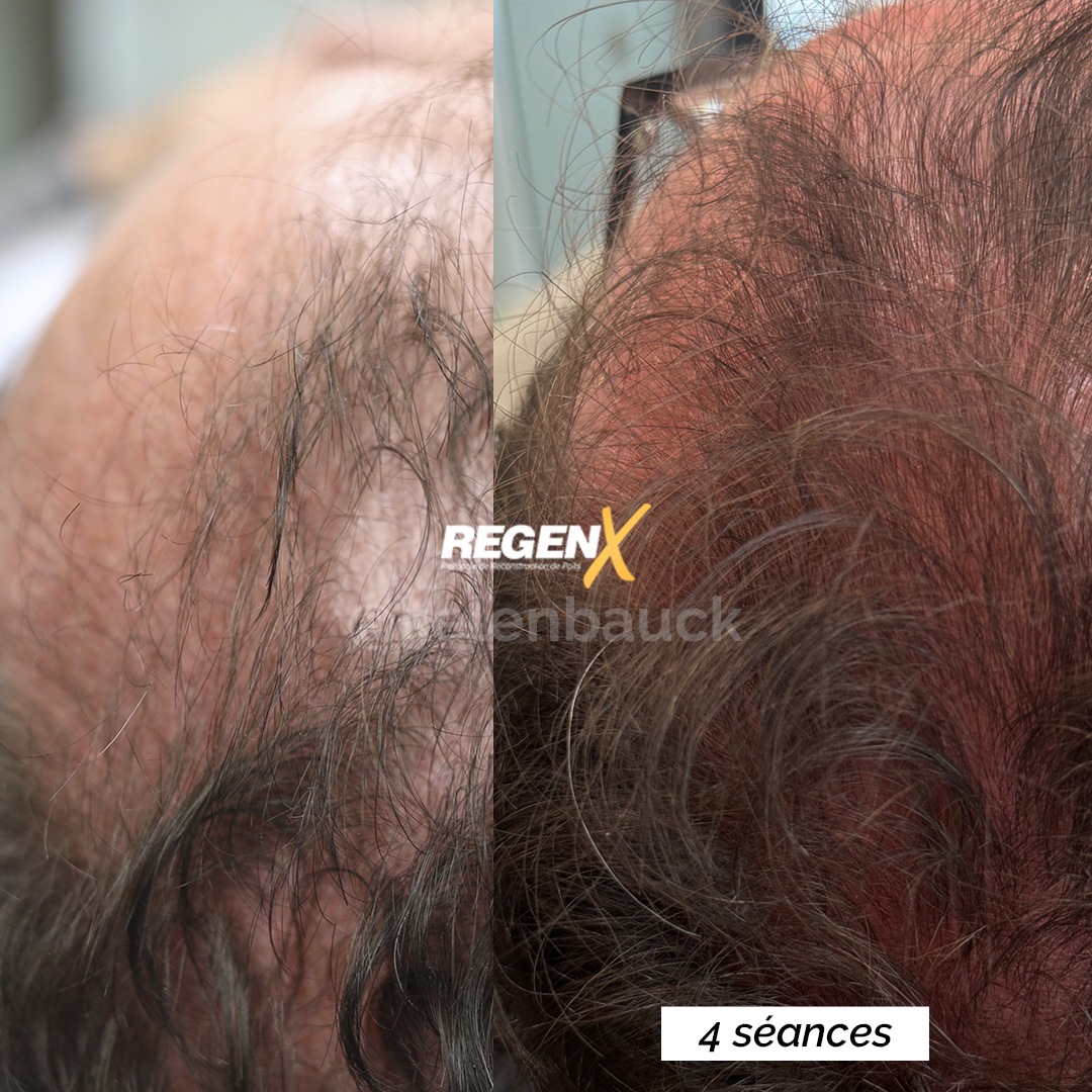 Recuperação do Cabelo