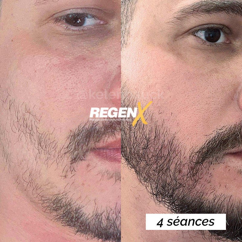 Recuperação de Barba